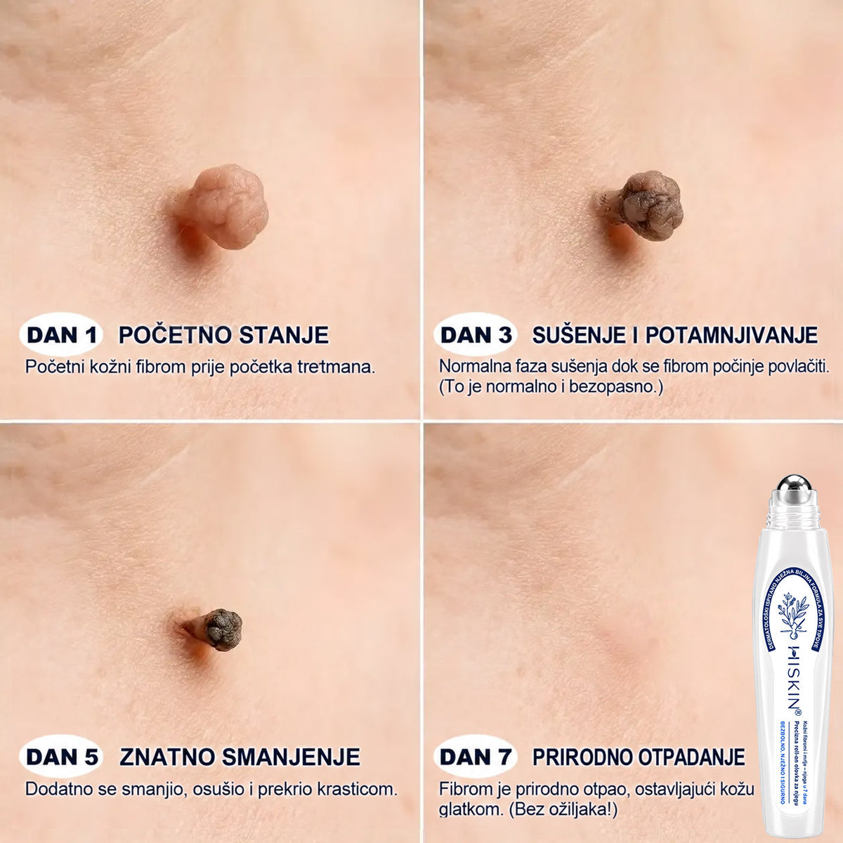 𝐇𝐈𝐒𝐊𝐈𝐍® 👩‍⚕️ 𝟕-𝐝𝐧𝐞𝐯𝐧𝐢 𝐭𝐫𝐞𝐭𝐦𝐚𝐧 𝐳𝐚 𝐮𝐤𝐥𝐚𝐧𝐣𝐚𝐧𝐣𝐞 𝐤𝐨ž𝐧𝐢𝐡 𝐢𝐳𝐫𝐚𝐬𝐥𝐢𝐧𝐚 𝐢 𝐦𝐫𝐥𝐣𝐚 – 𝐧𝐚𝐩𝐫𝐞𝐝𝐧𝐢 𝐩𝐫𝐞𝐜𝐢𝐳𝐧𝐢 𝐫𝐨𝐥𝐥-𝐨𝐧 𝐚𝐩𝐥𝐢𝐤𝐚𝐭𝐨𝐫 𝐳𝐚 𝐮𝐤𝐥𝐚𝐧𝐣𝐚𝐧𝐣𝐞 𝐤𝐨ž𝐧𝐢𝐡 𝐧𝐞𝐩𝐫𝐚𝐯𝐢𝐥𝐧𝐨𝐬𝐭𝐢, 𝐛𝐞𝐳 𝐛𝐨𝐥𝐢 𝐢 𝐨ž𝐢𝐥𝐣𝐚𝐤𝐚.