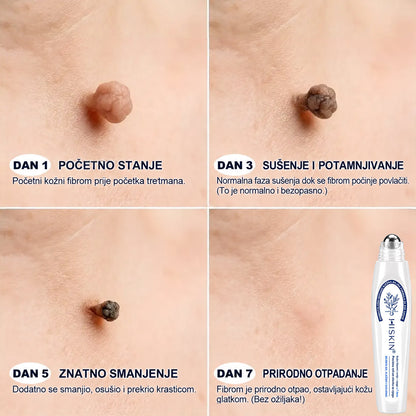 𝐇𝐈𝐒𝐊𝐈𝐍® 👩‍⚕️ 𝟕-𝐝𝐧𝐞𝐯𝐧𝐢 𝐭𝐫𝐞𝐭𝐦𝐚𝐧 𝐳𝐚 𝐮𝐤𝐥𝐚𝐧𝐣𝐚𝐧𝐣𝐞 𝐤𝐨ž𝐧𝐢𝐡 𝐢𝐳𝐫𝐚𝐬𝐥𝐢𝐧𝐚 𝐢 𝐦𝐫𝐥𝐣𝐚 – 𝐧𝐚𝐩𝐫𝐞𝐝𝐧𝐢 𝐩𝐫𝐞𝐜𝐢𝐳𝐧𝐢 𝐫𝐨𝐥𝐥-𝐨𝐧 𝐚𝐩𝐥𝐢𝐤𝐚𝐭𝐨𝐫 𝐳𝐚 𝐮𝐤𝐥𝐚𝐧𝐣𝐚𝐧𝐣𝐞 𝐤𝐨ž𝐧𝐢𝐡 𝐧𝐞𝐩𝐫𝐚𝐯𝐢𝐥𝐧𝐨𝐬𝐭𝐢, 𝐛𝐞𝐳 𝐛𝐨𝐥𝐢 𝐢 𝐨ž𝐢𝐥𝐣𝐚𝐤𝐚.
