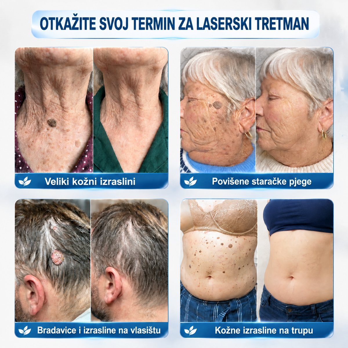 𝐇𝐈𝐒𝐊𝐈𝐍® 👩‍⚕️ 𝟕-𝐝𝐧𝐞𝐯𝐧𝐢 𝐭𝐫𝐞𝐭𝐦𝐚𝐧 𝐳𝐚 𝐮𝐤𝐥𝐚𝐧𝐣𝐚𝐧𝐣𝐞 𝐤𝐨ž𝐧𝐢𝐡 𝐢𝐳𝐫𝐚𝐬𝐥𝐢𝐧𝐚 𝐢 𝐦𝐫𝐥𝐣𝐚 – 𝐧𝐚𝐩𝐫𝐞𝐝𝐧𝐢 𝐩𝐫𝐞𝐜𝐢𝐳𝐧𝐢 𝐫𝐨𝐥𝐥-𝐨𝐧 𝐚𝐩𝐥𝐢𝐤𝐚𝐭𝐨𝐫 𝐳𝐚 𝐮𝐤𝐥𝐚𝐧𝐣𝐚𝐧𝐣𝐞 𝐤𝐨ž𝐧𝐢𝐡 𝐧𝐞𝐩𝐫𝐚𝐯𝐢𝐥𝐧𝐨𝐬𝐭𝐢, 𝐛𝐞𝐳 𝐛𝐨𝐥𝐢 𝐢 𝐨ž𝐢𝐥𝐣𝐚𝐤𝐚.