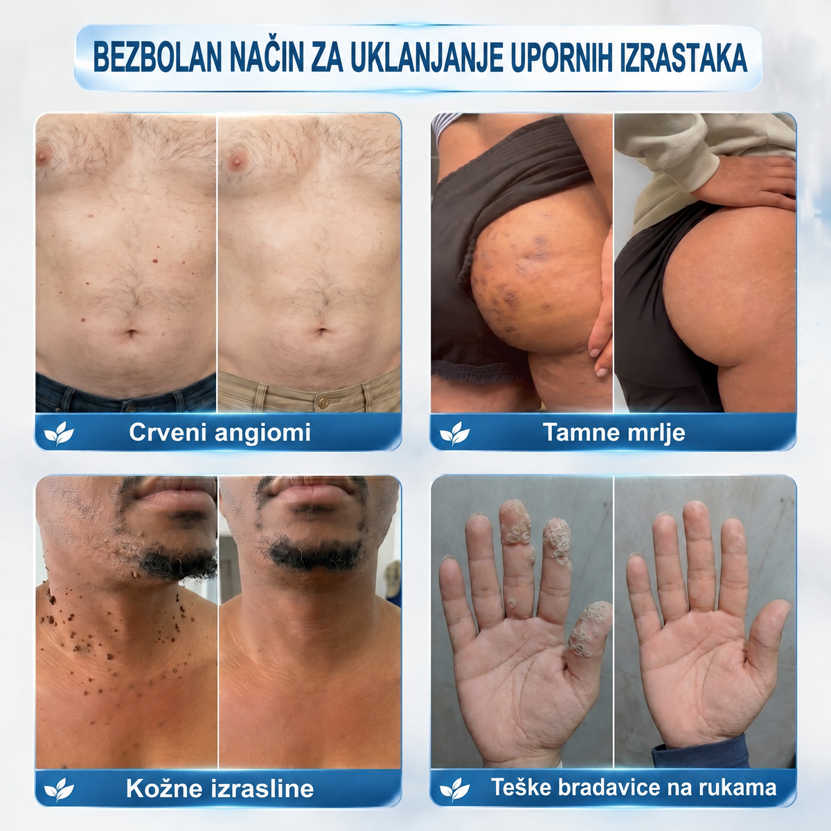 𝐇𝐈𝐒𝐊𝐈𝐍® 👩‍⚕️ 𝟕-𝐝𝐧𝐞𝐯𝐧𝐢 𝐭𝐫𝐞𝐭𝐦𝐚𝐧 𝐳𝐚 𝐮𝐤𝐥𝐚𝐧𝐣𝐚𝐧𝐣𝐞 𝐤𝐨ž𝐧𝐢𝐡 𝐢𝐳𝐫𝐚𝐬𝐥𝐢𝐧𝐚 𝐢 𝐦𝐫𝐥𝐣𝐚 – 𝐧𝐚𝐩𝐫𝐞𝐝𝐧𝐢 𝐩𝐫𝐞𝐜𝐢𝐳𝐧𝐢 𝐫𝐨𝐥𝐥-𝐨𝐧 𝐚𝐩𝐥𝐢𝐤𝐚𝐭𝐨𝐫 𝐳𝐚 𝐮𝐤𝐥𝐚𝐧𝐣𝐚𝐧𝐣𝐞 𝐤𝐨ž𝐧𝐢𝐡 𝐧𝐞𝐩𝐫𝐚𝐯𝐢𝐥𝐧𝐨𝐬𝐭𝐢, 𝐛𝐞𝐳 𝐛𝐨𝐥𝐢 𝐢 𝐨ž𝐢𝐥𝐣𝐚𝐤𝐚.